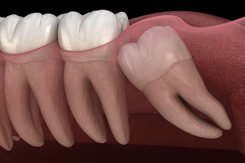 All about Tooth Impaction