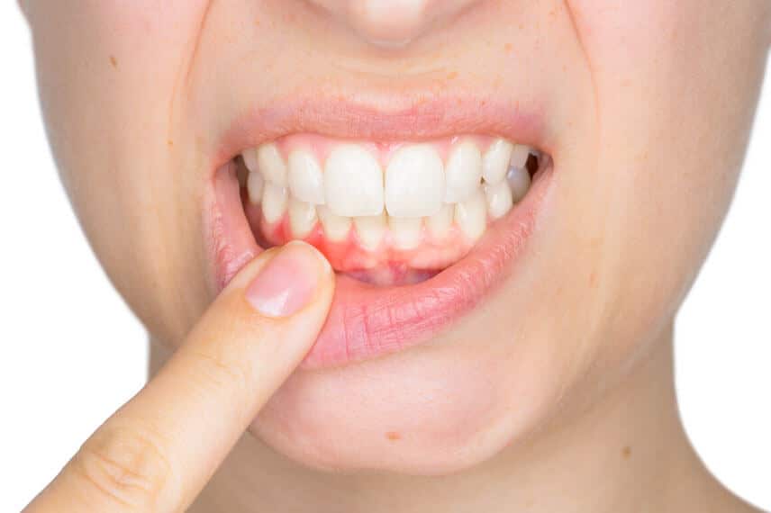 Understanding the Various Stages of Periodontal (Gum) Disease